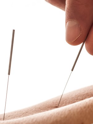 Medicinsk Akupunktur på Stureplan i Stockholm